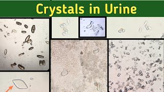 Identify Urine crystals  Crystals in Urine under Microscope  Urine Microscopic Examination [upl. by Arakal]