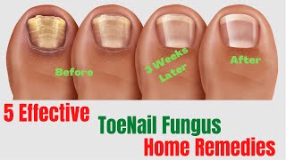 5 Natural Remedies For Toenail Fungus – Toenail Fungus Treatment At Home [upl. by Victoria]