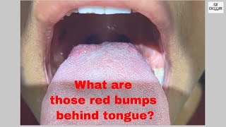 What are Red bumps behind Tongue  Taste Buds How to keep them clean and healthy [upl. by Paz]