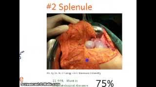 Surgical Anatomy 1 Spleen [upl. by Acisej426]