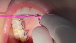 Interesting Putting on elastic orthodontic power chain on lingual braces [upl. by Siroled]