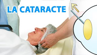 La cataracte expliquée par Dr Stopek [upl. by Clary]