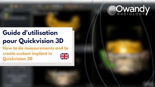 6 How to do measurements and to create custom implant in Quickvision 3D [upl. by Howlond]