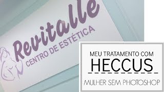 Heccus  meu tratamento [upl. by Alston]