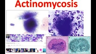 Actinomycosis Medschooltutorial [upl. by Topper187]