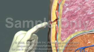 Thoracotomy  Normal Procedure [upl. by Atalie]