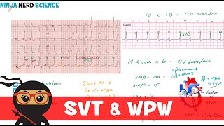 Rate and Rhythm  Supraventricular Tachycardia SVT and WolffParkinsonWhite WPW Syndrome [upl. by Normalie]