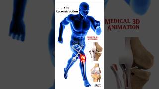 ACL Reconstruction medical animation 3d short Biology with Aliya [upl. by Tsui329]