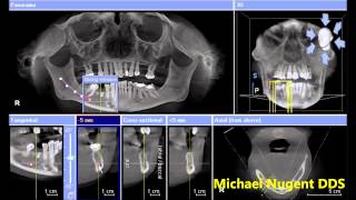 Dental Implants  Cone Beam CT  Pasadena Texas Dentist [upl. by Aksel]