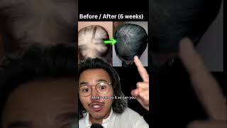 Hair loss IS reversible dermaroller hair dermarollertreatment [upl. by Shay92]