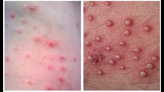 Home Remedies for Folliculitis  How to Get Rid of Folliculitis At Home [upl. by Waldron]