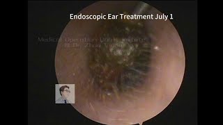 Ear wax removal CERUMEN cleaning 🧹 20230701 [upl. by Dewhirst]