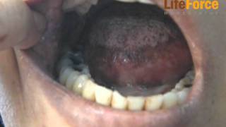 Oral Lichen Planus with Submucous Fibrosis Treated at Life Force [upl. by Arty192]