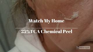 Home Tca Peel 25 Skin Obsession [upl. by Aramac159]