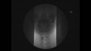 VFS  Videofluoroscopy Assessment of Swallowing  Röntgen Schluckakt [upl. by Willow]