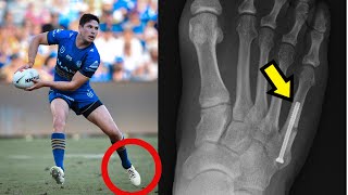 Mitchell Moses Foot Fracture SURGERY Explained [upl. by Nyrhtakyram]