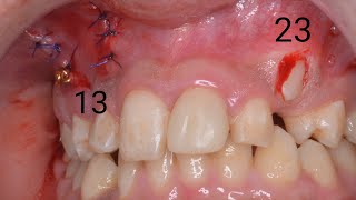 VISTA flap for impacted upper right canine using closed traction technique by Dr Ebrahim Elhadad [upl. by Aurel]