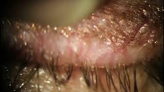 Extracting Dead Demodex Mite Carcasses from Eyelid [upl. by Lavotsirc497]