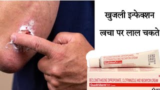 use of QUADRIDERM RF CREAM खुजली इन्फेक्शन त्वचा पर लाल चकते सूजन से राहत दिलाए [upl. by Nilreb]