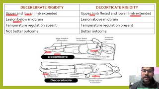 DIFFERENCE BETWEEN DECEREBRATE AND DECORTICATE RIGIDITY DECORTICATERIGIDITY DECEREBRATERIGIDITY [upl. by Anaitak]