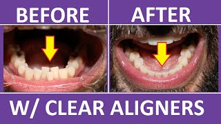 Invisalign Braces Before and After Overbite Crowding Teeth Cost Pain Tips 3M Clear Aligners [upl. by Epp]