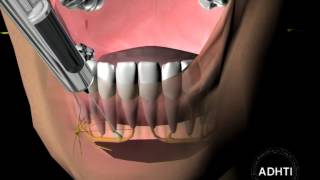 инфильтрационная анестезия на нижней челюстиinfiltration anesthesia in the mandible [upl. by Strohl818]