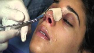 The Kotler Nasal Airway  Removal of the Airway [upl. by Ellener37]