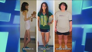 How an Anorexic Can Become a Binge Eater [upl. by Attenahs]