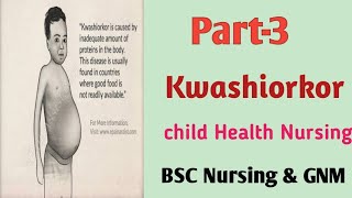 Kwashiorkor20 October 2020 [upl. by Brazee]