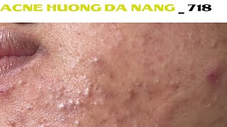 Acne Treatment Huong Da Nang 718  Remove Blackheads [upl. by Nahgiem]