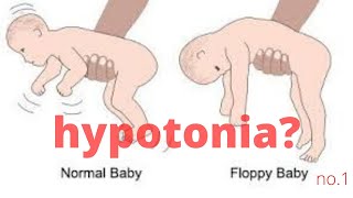 NDT Therapy in a Hypotonic quadriplegic child with Cerebral Palsy Easy handlings [upl. by Allayne]