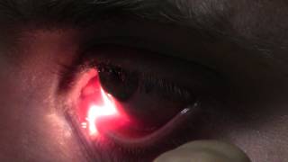 Ophthalmic Skills Video  Basics in Slit Lamp Examination [upl. by Nerty828]