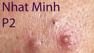 Acne Treatment Huong Da Nang 029  Treatment for Nhat Minh Part 2 [upl. by Critchfield999]