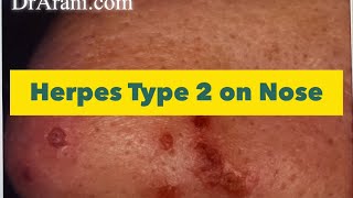 Herpes type 2 on nose and nostril  HSV 2 by oral contact  nasal herpetic sore [upl. by Eitsym]