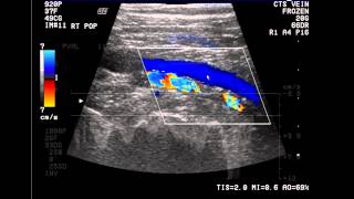 Introduction to the Lower Extremity Venous Doppler Study [upl. by Lrigybab]