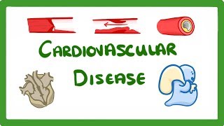 GCSE Biology  Why Do We Get Heart Disease and How to Treat It  Cardiovascular Disease CVD 47 [upl. by Dera45]