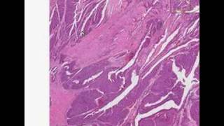 Histopathology KidneyTransitional cell carcinoma [upl. by Lysander]