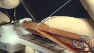 Hamstring Autograft Technique for ACL Reconstruction Surgery [upl. by Inaj]