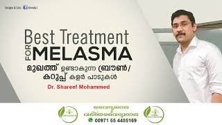 Melasma Malayalam  മുഖത്തു ഉണ്ടാവുന്ന കറുത്ത പാടുകള്‍  Mukhathe Karutha Padukal Maran Dr Shareef [upl. by Hsetim73]