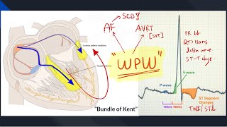 WolffParkinsonWhite WPW Syndrome  A practical review for Med student amp GPs [upl. by Humo]