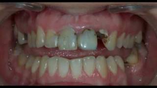 Dental composite restoration [upl. by Akinna]