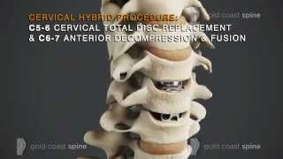 Cervical Hybrid – Cervical Spine Surgery [upl. by Lleihsad113]