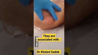 Large Lipoma cystremoval Dr Khaled Sadek [upl. by Miller]