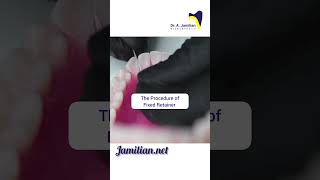 Procedure of Fixed Retainer dentist bracing fixedretainerRetainerOrthodonticsRetention [upl. by Adlesirc959]