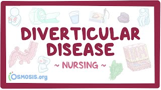 Diverticular disease Clinical Nursing Care [upl. by Nylecyoj]