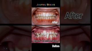 25 months for orthodontist braces orthodontist dentist dental shorts viral [upl. by Huggins]