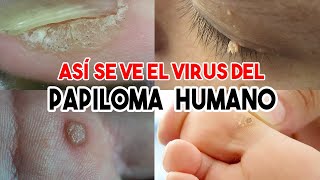 TODOS los tipos de VERRUGAS que causa el VIRUS DEL PAPILOMA HUMANO [upl. by Anialad703]