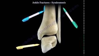 Ankle Fractures and the Syndesmosis  Everything You Need To Know  Dr Nabil Ebraheim [upl. by Arv748]