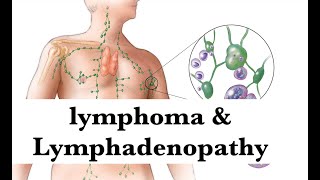 lymphoma amp lymphadenopathy pathology Hematologyamp Oncology Integrated lecture by ASM Minds Team [upl. by Dnalyk207]