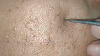 blackheads removal 2023  sac dep spa blackheads removal 2023  skin treatments sac dep spa 2023 [upl. by Hali]